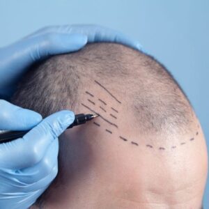Female Hair Loss: Is a Hair Transplant the Right Solution?