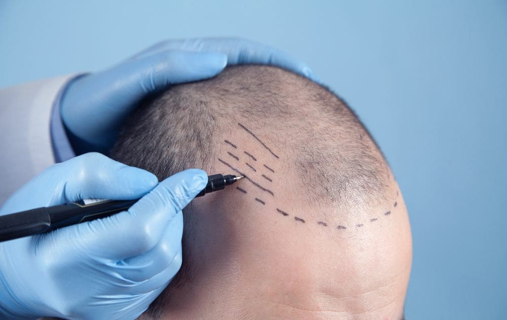 Female Hair Loss: Is a Hair Transplant the Right Solution?